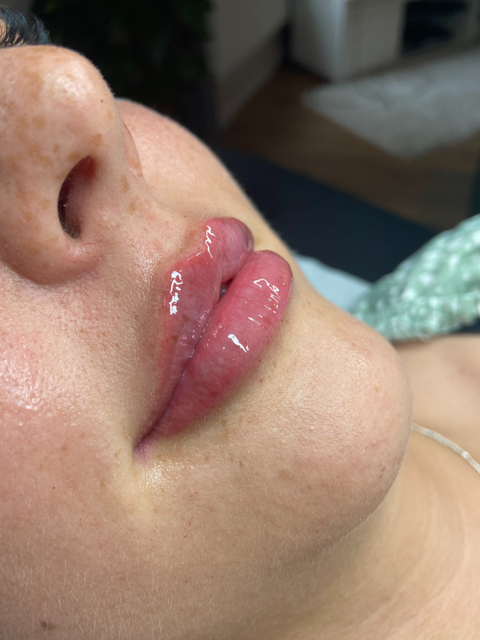 Dermal filler before and after result
