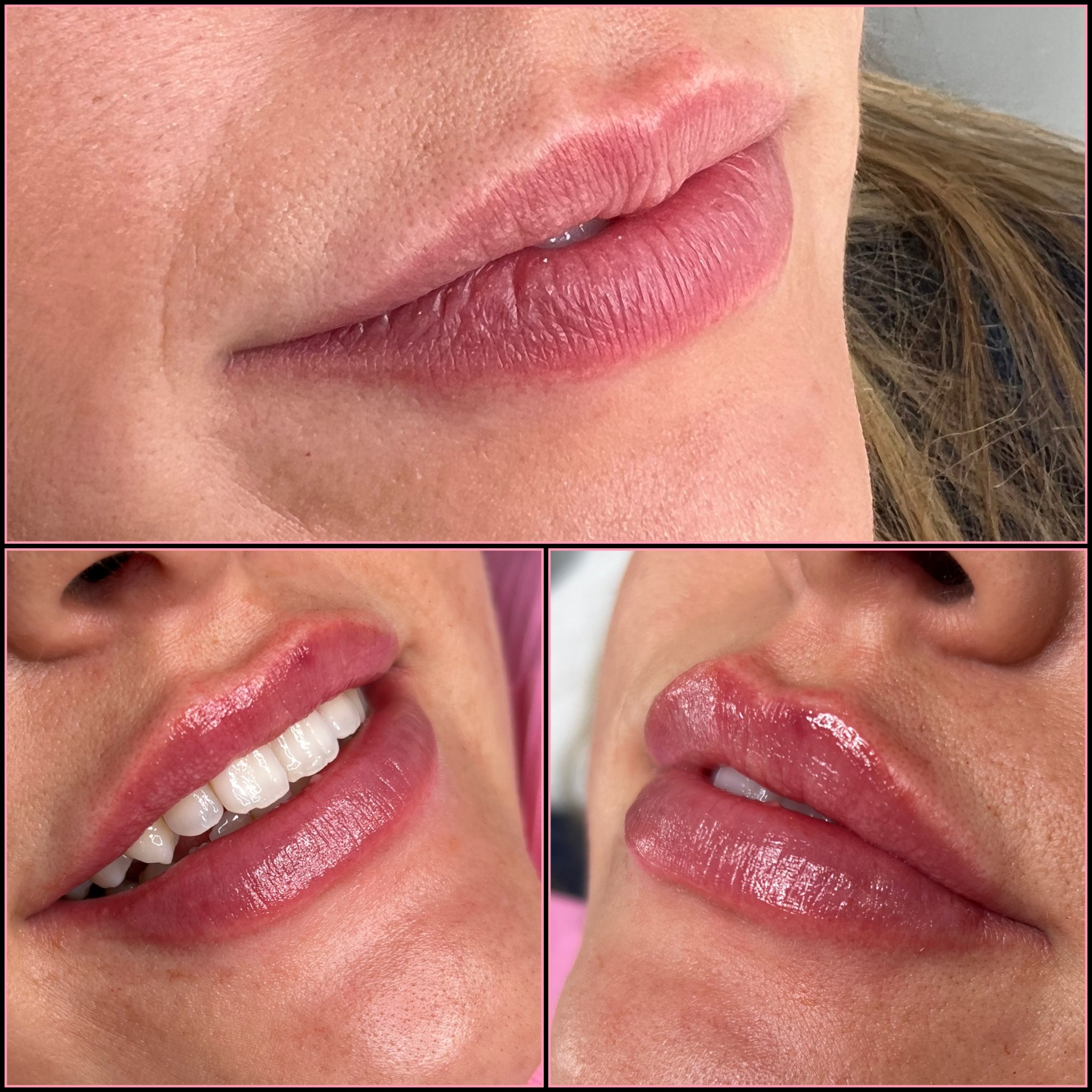 Lip enhancement collage