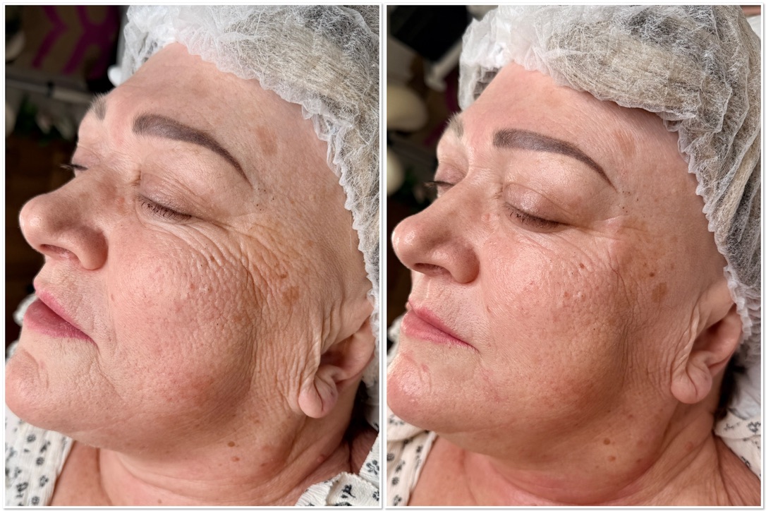 Skin rejuvenation before and after
