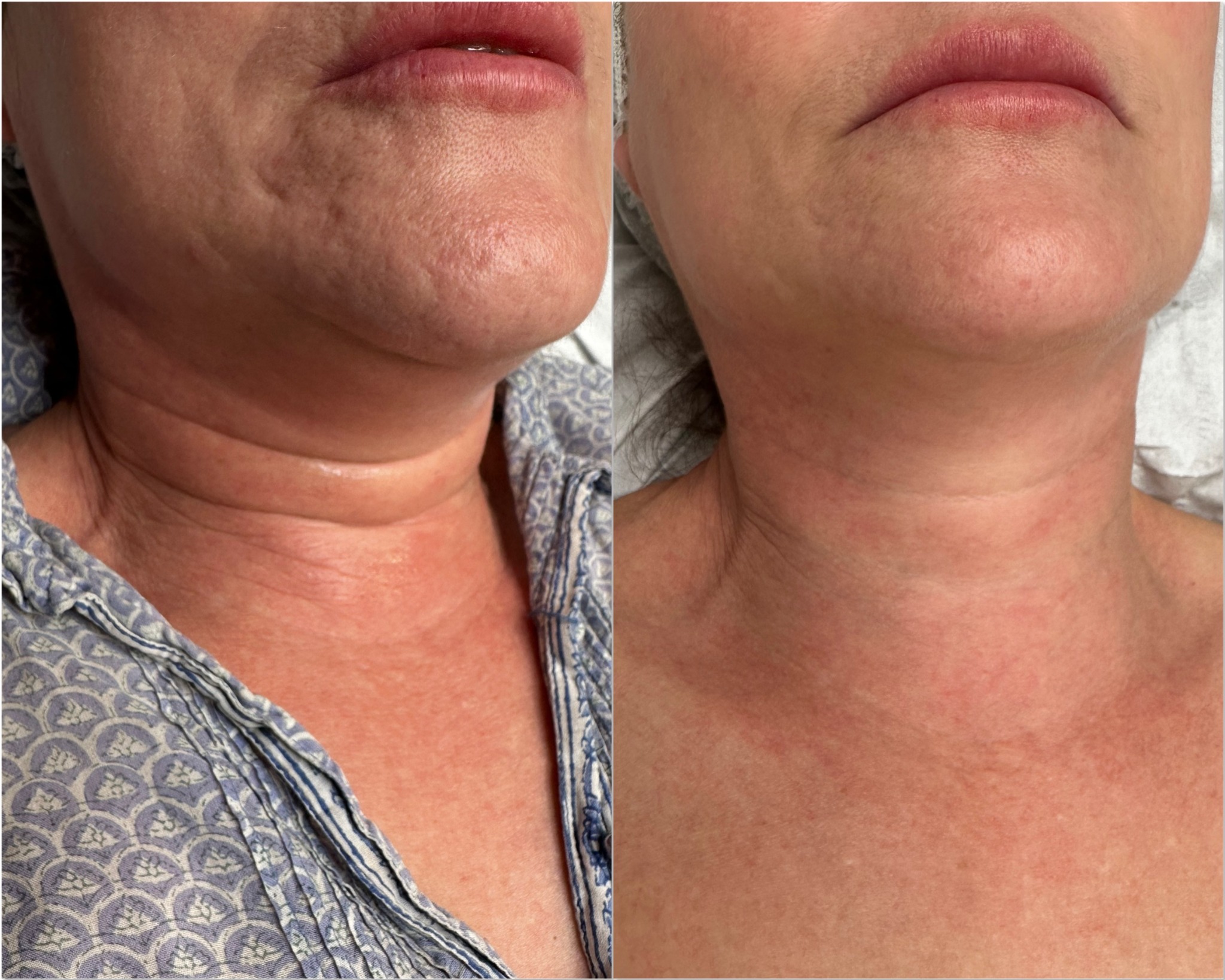 Neck skin before and after
